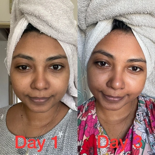 3-Day Pigmentation Glow Before and After