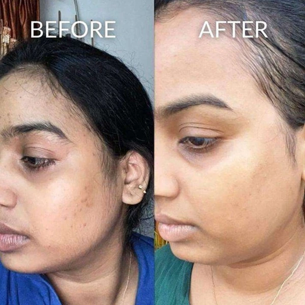 Cheek Pigmentation & Acne Spots Fading Before and After