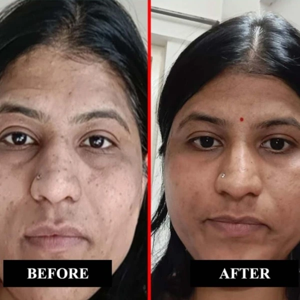 Deep Melasma & Pigmentation Reversal Before and After