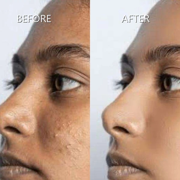 Skin Texture & Hyper-Pigmentation Smoothing Before and After