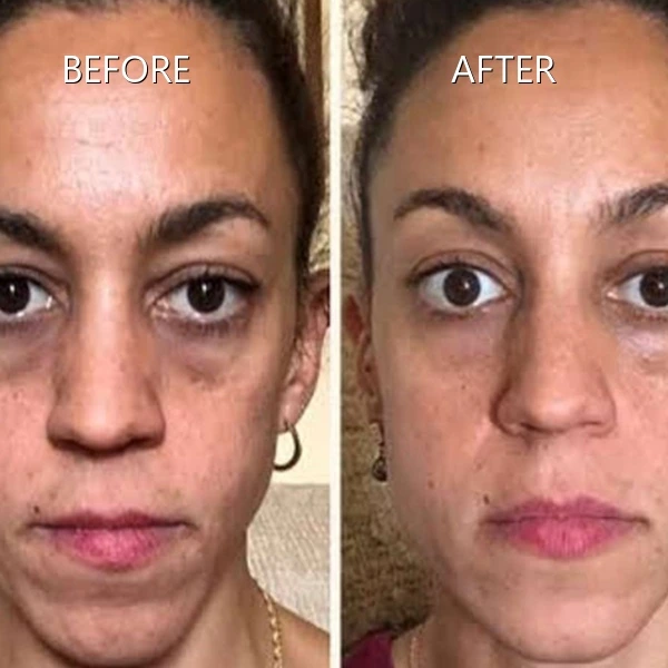 Under-Eye Dark Circles & Fatigue Bags Reduction Before and After